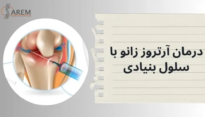 درمان آرتروز زانو با سلول بنیادی