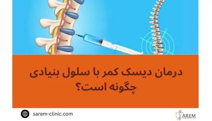 درمان دیسک کمر با سلول بنیادی