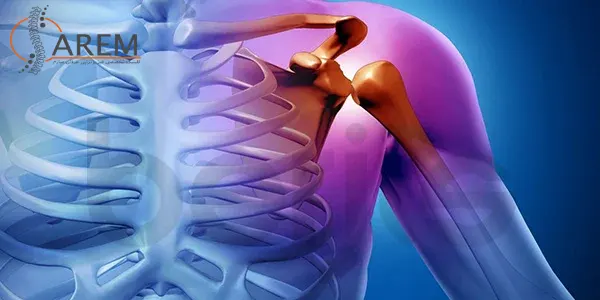 علائم پارگی تاندون شانه