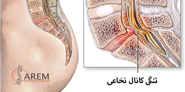 فیزیوتراپی تنگی کانال نخاعی