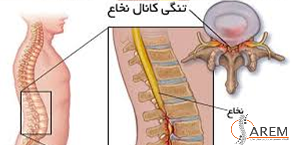 فیزیوتراپی تنگی کانال نخاعی