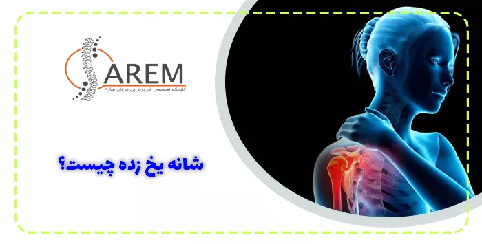 شانه یخ زده چیست؟