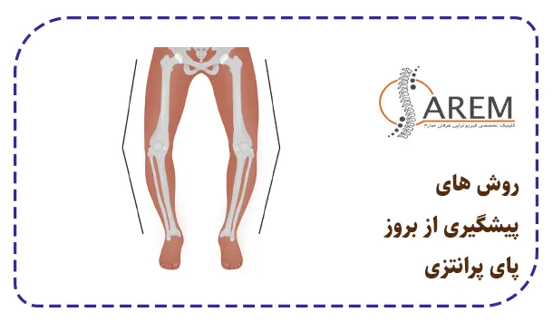 روش های پیشگیری از بروز پای پرانتزی