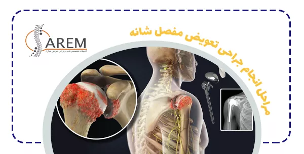 مراحل انجام جراحی تعویض مفصل شانه