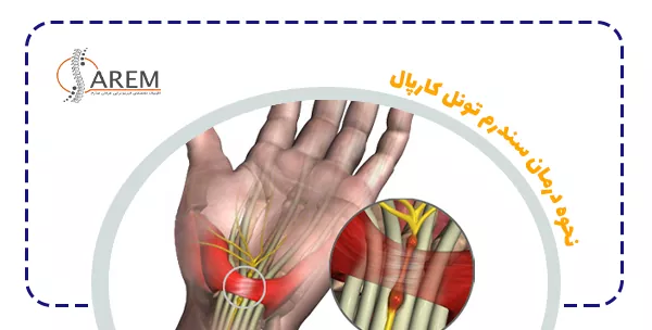 نحوه درمان سندرم تونل کارپال
