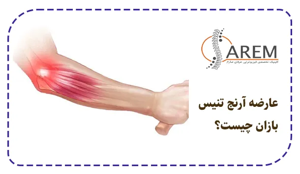 عارضه آرنج تنیس بازان چیست؟