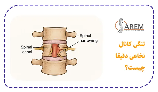 تنگی کانال نخاعی دقیقا چیست؟