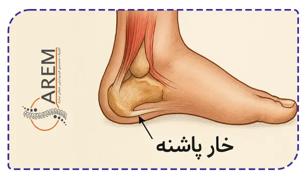 خارپاشنه چیست خارپاشنه چیست