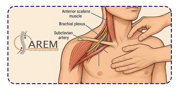 سندرم توراسیک اوت لت چیست؟