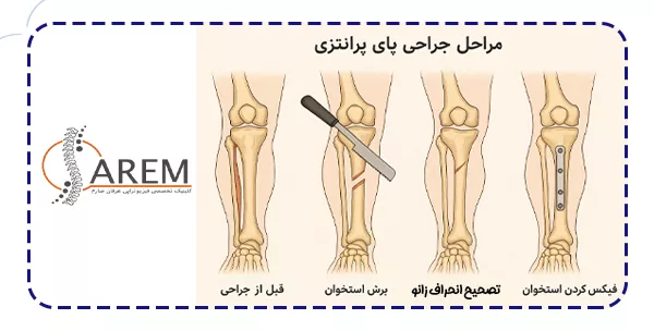 مراحل جراحی پای پرانتزی